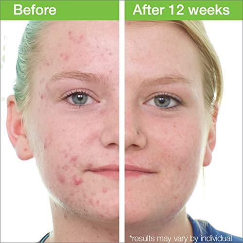 MD Complete Acne Clearing Duo Step 1 Salicylic Acid 2.0% Cleanser 4.2 fl oz + Step 2 Benzoyl Peroxide 4.5% Breakout Treatment 1.0 fl oz |60 Day Supply
