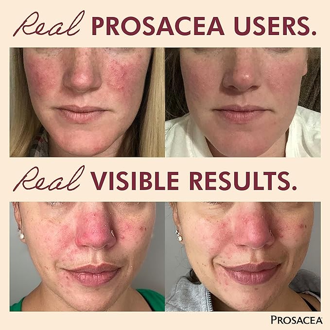 Prosacea - Medicated Rosacea Treatment for Face - Heals Rosacea Symptoms of Redness, Pimples and Irritation - Fragrance Free - 0.75 oz