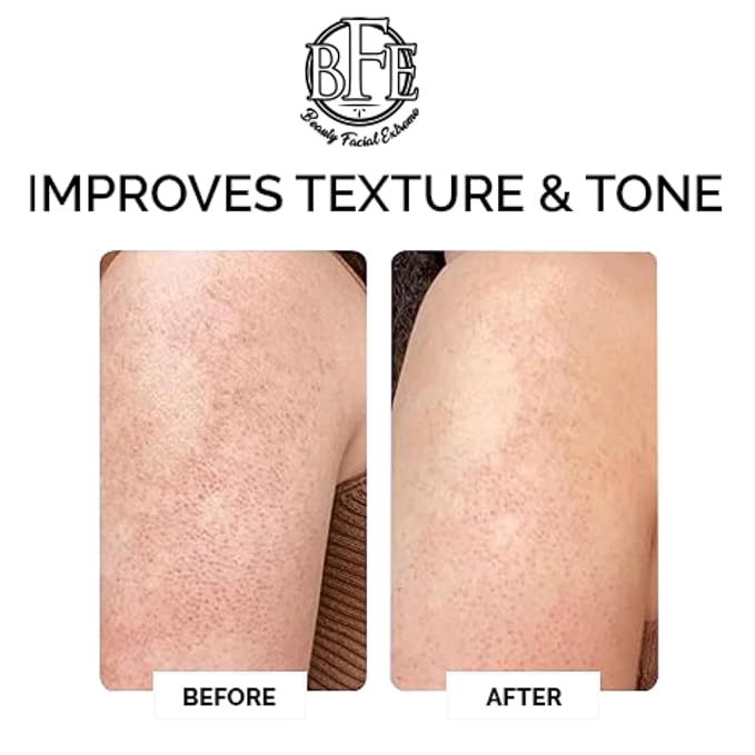 Keratosis Pilaris Exfoliating Body Lotion– 12% Lactic Acid. Provides Immediate Moisture & Gentle Exfoliation to Treat symptoms Associated with Keratosis Pilaris & Dry, Bumpy Skin Conditions.