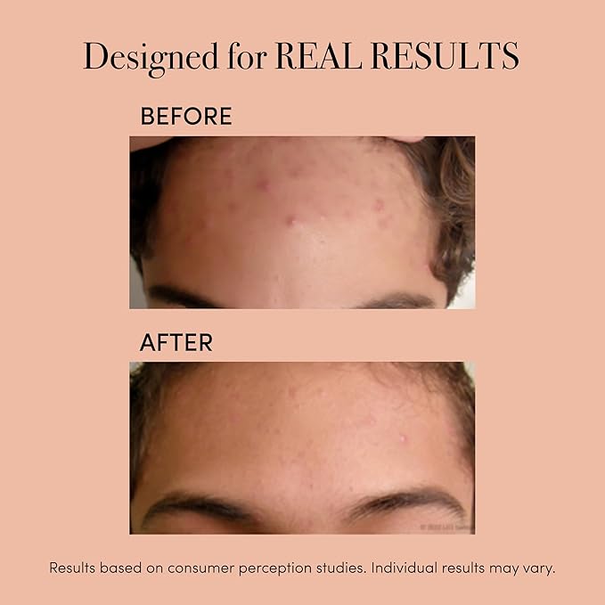 reVive Light Therapy Clinical Acne Treatment for Face, Blue Light Therapy Device