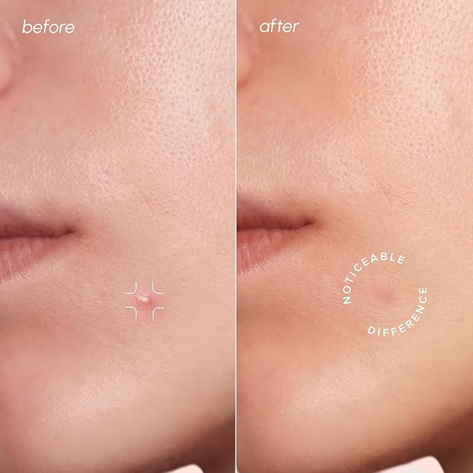 MAREE Pimple Patches for Face - Acne Clearing Device - Clear Acne Patches for Face - Invisible Hydrocolloid Patch Parches Para Acne Stickers Zit Dots - Cystic Zit Healing Blemish Pinple Covers