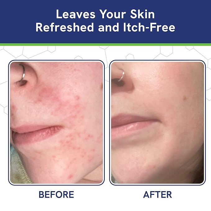 Itch Cream for Itchy Skin Relief - Moisturizing Cream & Face Lotion for Women - Redness Relief for Face & Body Cream - Hydrating Face Cream for Dry Skin & Itchy Scalp Relief - Anti Itch Lotion (4oz)