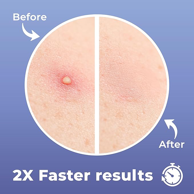 Pimple Patches for Face (240 Patches), Hydrocolloid Acne Patches with Tea Tree Oil & Salicylic Acid, Pimple Patch Pimple Stickers, Hydrocolloid Patch Acne Dots Acne Pimple Patches For Face