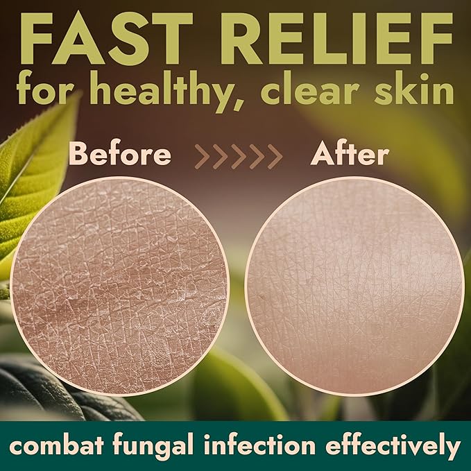 Terramed Just Think Comfort Antifungal & Antibacterial Soap & Body Wash with Tea Tree Oil | Treats Ringworm, Back Acne, Eczema & Jock Itch | Antibacterial Body Soap For Men And Women (16.9 oz)