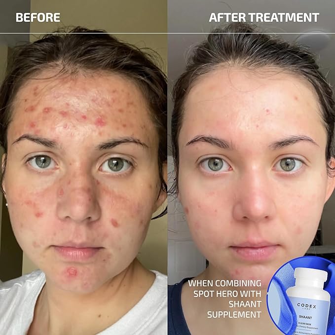 Codex Labs Shaant Spot Hero – Sulfur & Green Tea Gel for Blemish-Prone Skin | Fast-Drying Formula for Clear-Looking Skin | 0.5oz